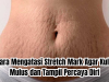 cara mengatasi stretch mark