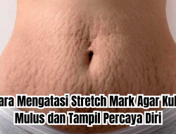 cara mengatasi stretch mark