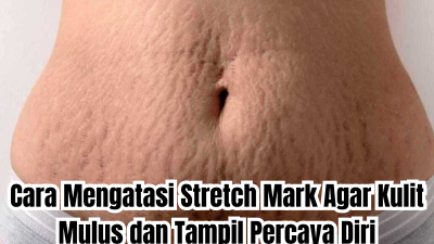 cara mengatasi stretch mark