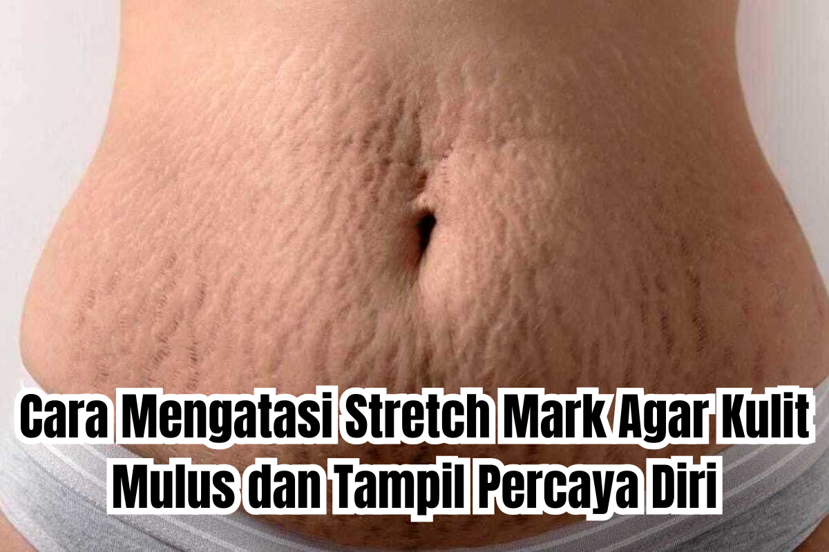 cara mengatasi stretch mark