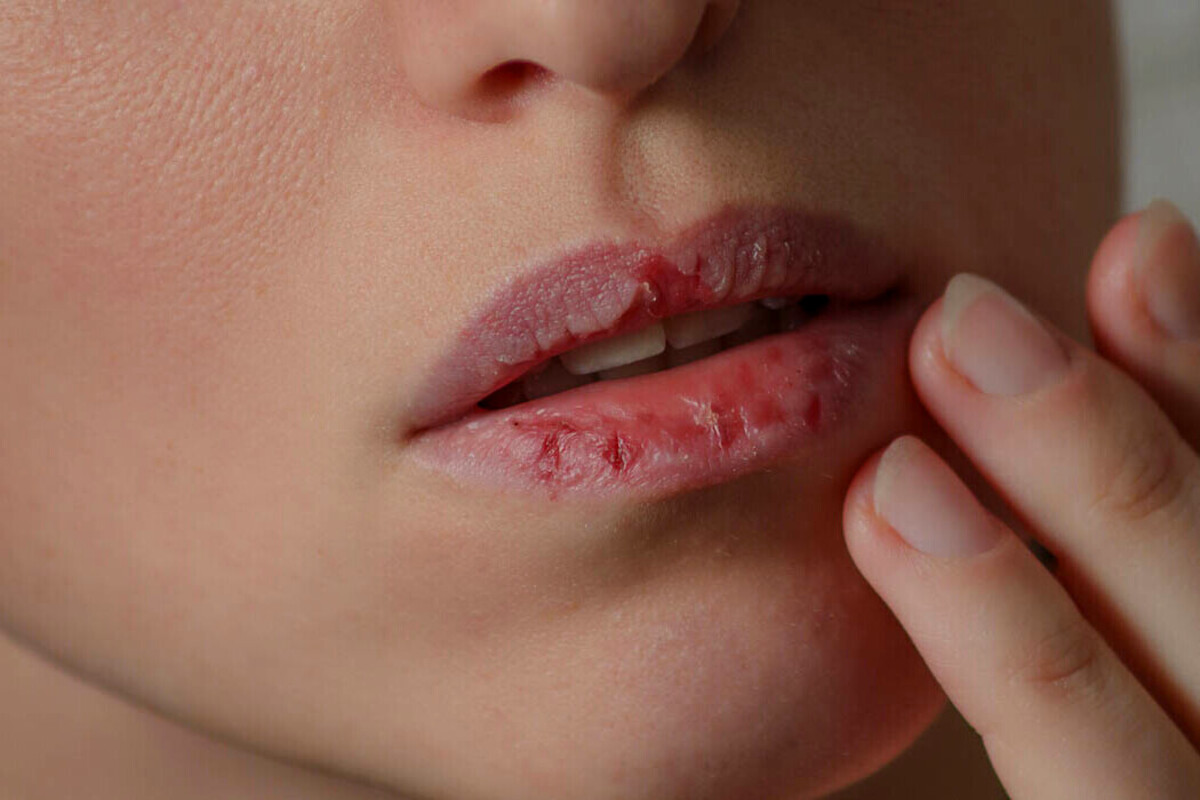 Salah satu gejala bau mulut yaitu mulut atau bibir yang kering.
