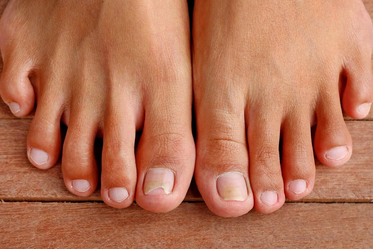 Cara Menghilangkan Bau Kaki - Kuku Kaki