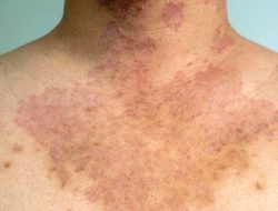 Artikel kali ini membahas mengenai beberapa jenis infeksi jamur kulit yang penting untuk kita pahami dan cegah.