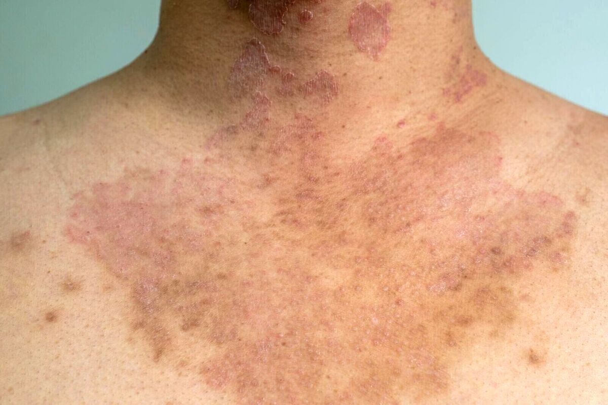 Artikel kali ini membahas mengenai beberapa jenis infeksi jamur kulit yang penting untuk kita pahami dan cegah.