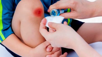 Artikel kali ini memberikan berbagai cara merawat luka agar tidak meninggalkan bekas luka yang bisa Anda lakukan saat kulit Anda terluka.