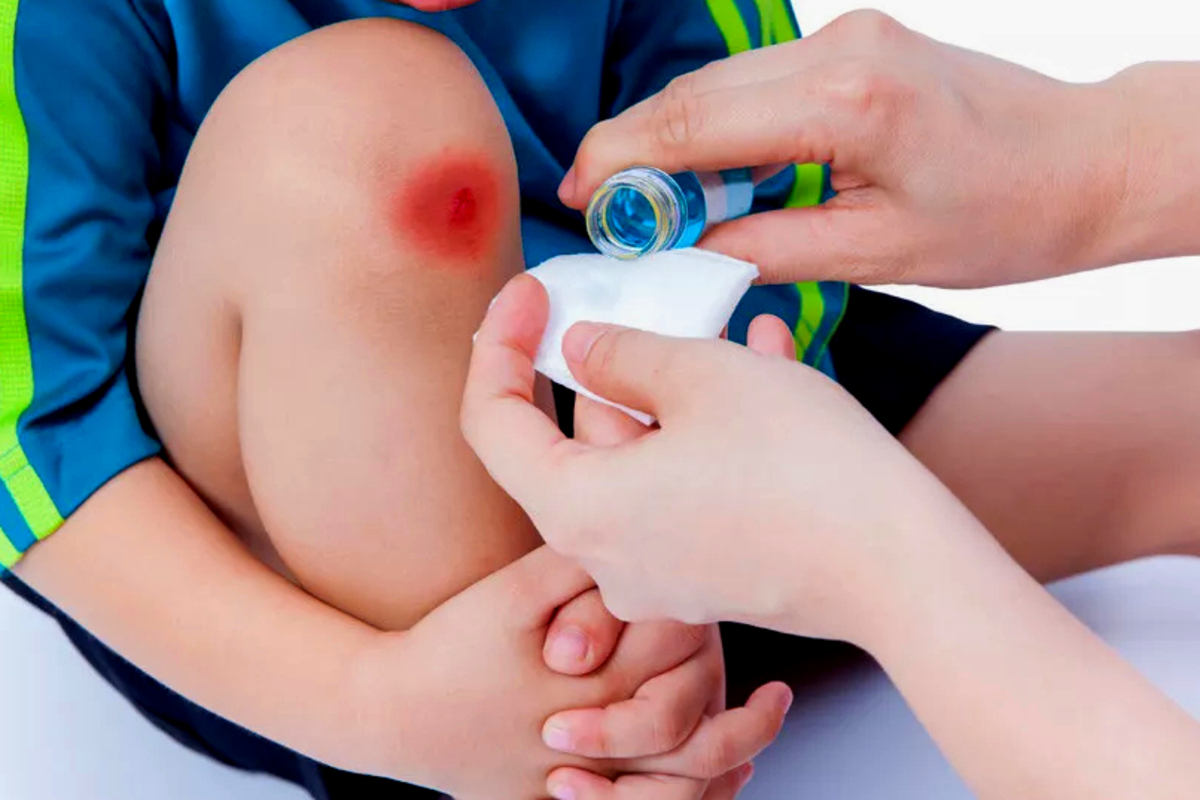 Artikel kali ini memberikan berbagai cara merawat luka agar tidak meninggalkan bekas luka yang bisa Anda lakukan saat kulit Anda terluka.