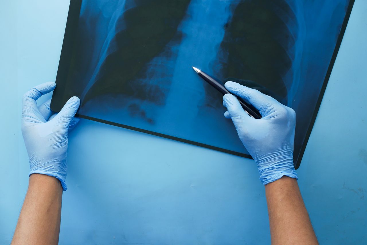 Ilustrasi Pneumonia (pexels.com)
