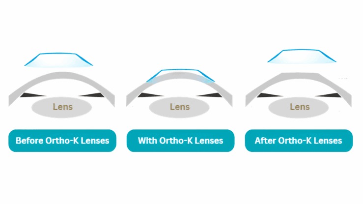 Orthokeratology (Ortho-K) / (oasiseye)